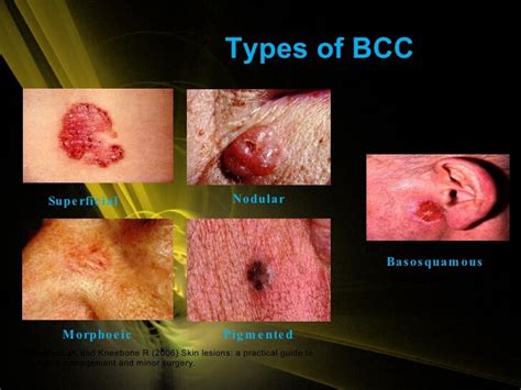 How do you treat aggressive BCC?