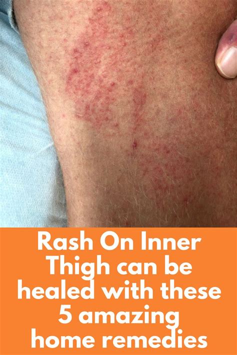 How do you treat an inner thigh rash naturally?