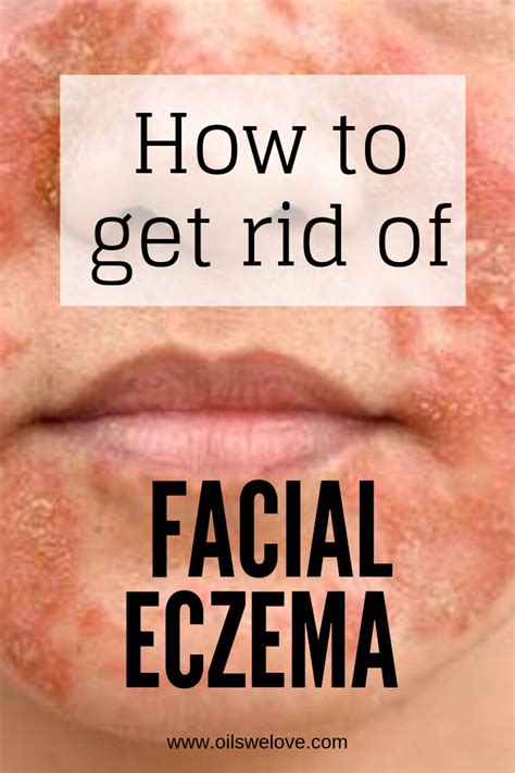 How do you treat eczema peeling skin?