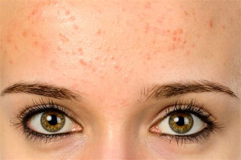 How do you treat fungus on your face?