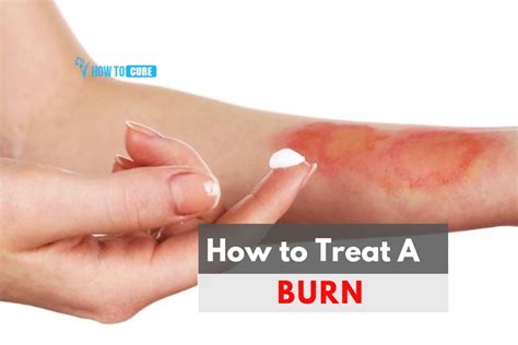 How do you treat hot glue burns on skin?
