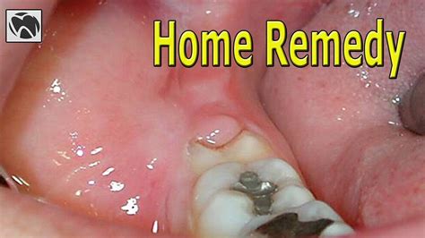 How do you treat pericoronitis at home?