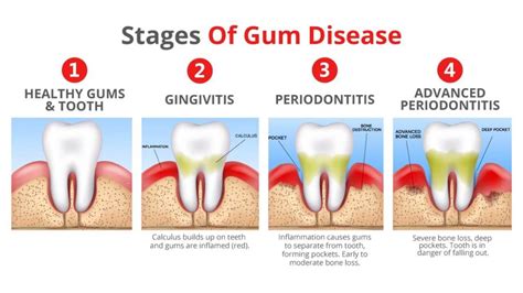 How do you treat periodontitis early?