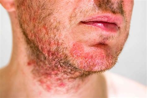 How do you treat seborrheic dermatitis aggressively?