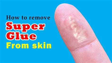 How do you treat super glue burns?