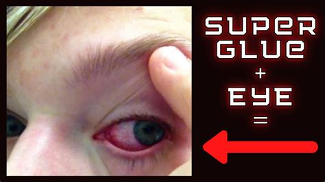 How do you treat super glue in your eyes?