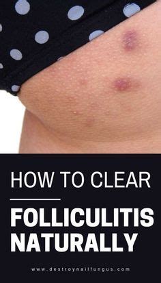 How do you unclog folliculitis?
