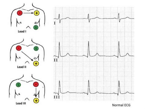 How do you use a 3 lead cardiac monitor?