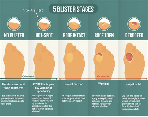 How do you walk with blisters?