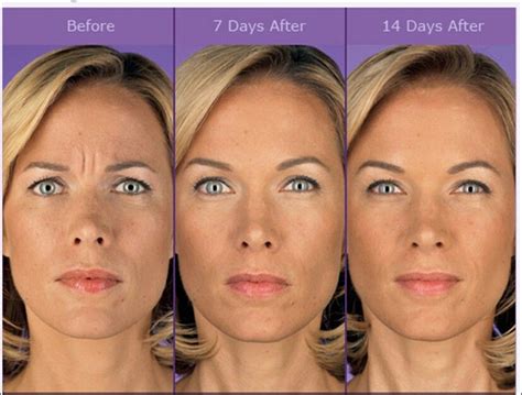 How does Botox look as you age?