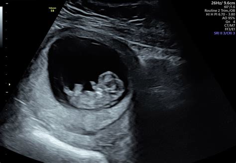 How does a 10 week ultrasound look like?