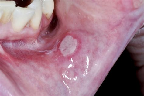 How does an infected mouth look like?