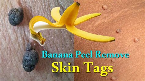 How does banana peel remove skin tags?