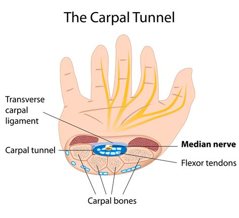 How does carpal tunnel affect quality of life?