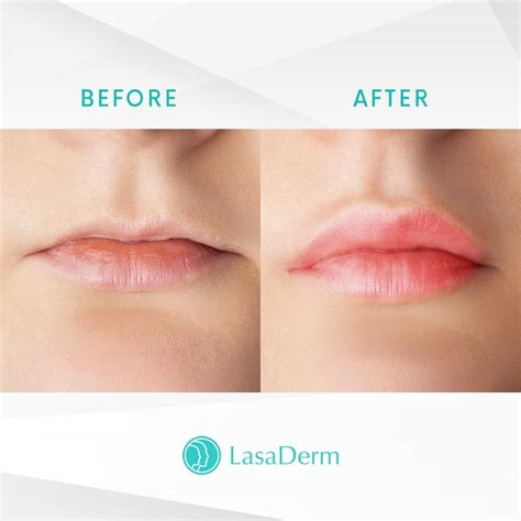 How does kissing feel after lip filler?