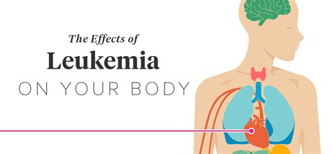 How does leukemia affect you physically?