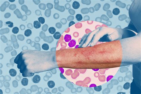 How does leukemia show on skin?