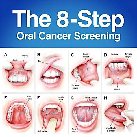 How does oral cancer start?
