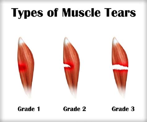 How easy is it to tear a muscle?