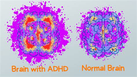 How far behind is the ADHD brain?