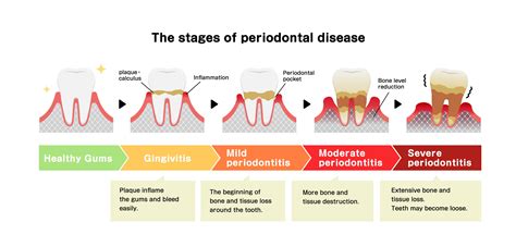 How fast does periodontitis progress?