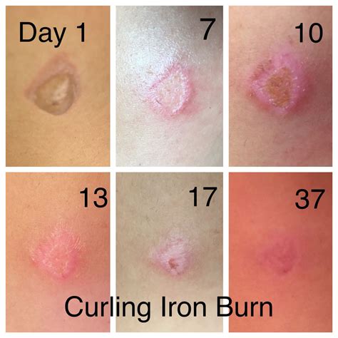 How heal skin faster after burn?