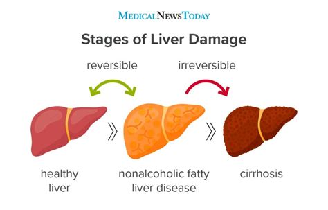 How high is ALT in fatty liver?