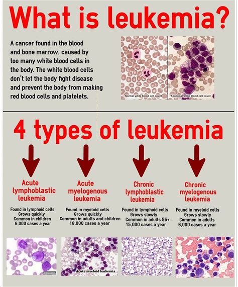 How is leukemia noticed?