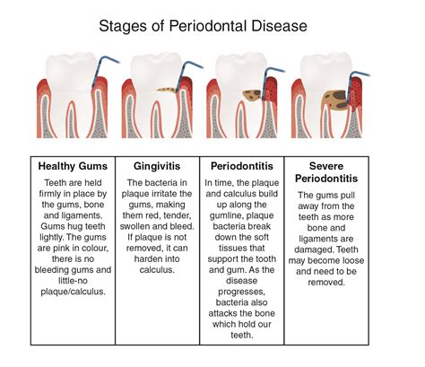 How is periodontitis treated in 2023?