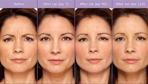 How long after Botox can it spread?