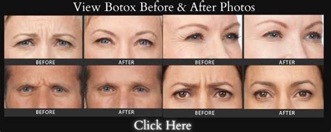 How long after Botox can you get waxed?