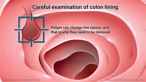 How long after a colonoscopy do you fart?