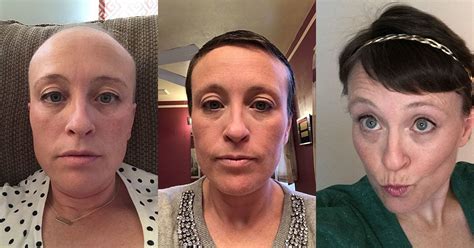 How long after chemo do you lose your hair?