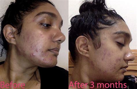 How long after exfoliating can you see results?