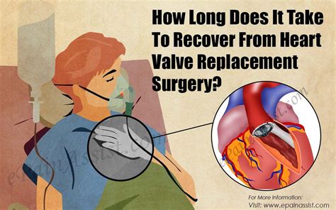 How long after valve replacement can I drive?