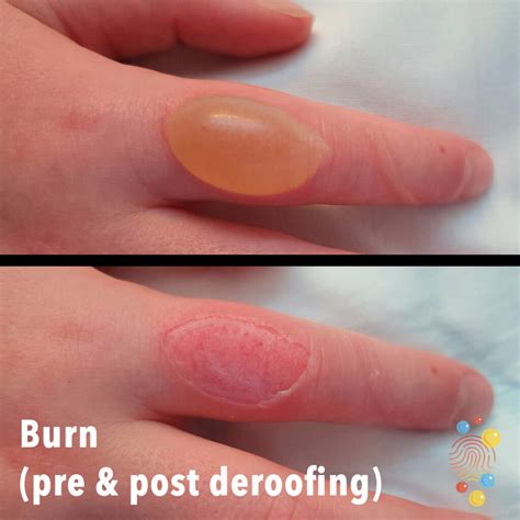 How long before a burn turns into a blister?