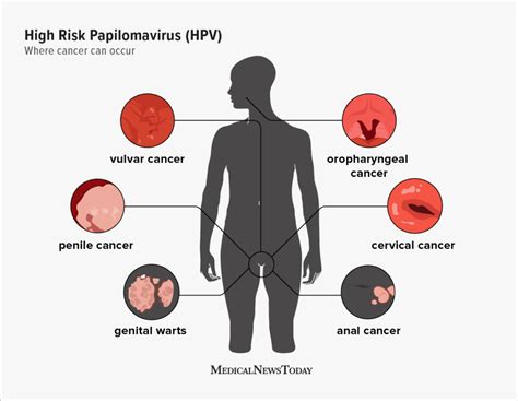 How long can HPV 6 and 11 be dormant?