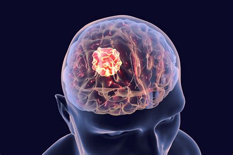 How long can I have a brain tumor without knowing?