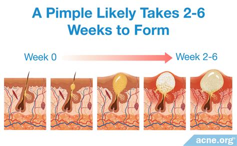 How long can a deep pimple last?