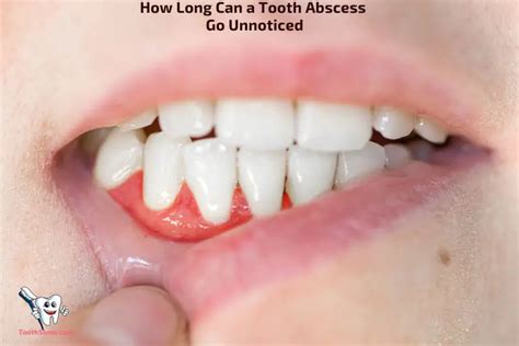 How long can a dental abscess go unnoticed?