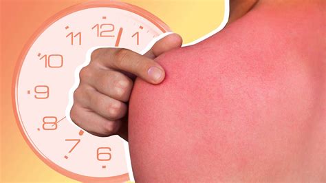 How long can a second-degree sunburn last?