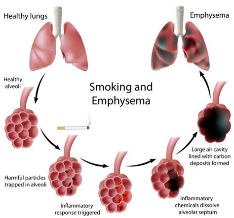 How long can a smoker live with COPD?