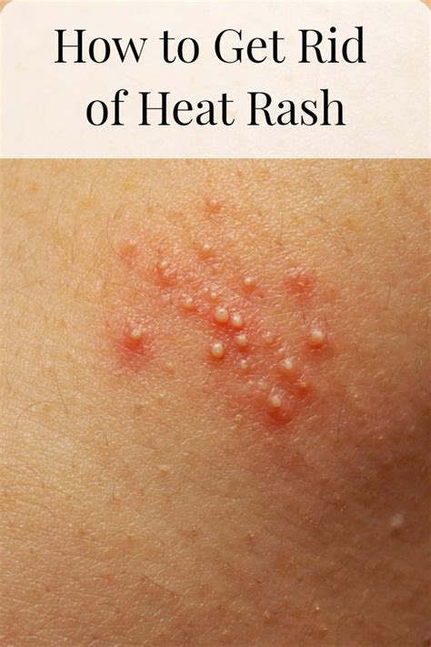 How long can heat rash last?