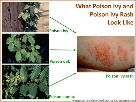 How long can poison ivy spread on you?