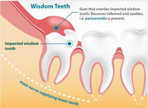 How long can you go with an infected wisdom tooth?