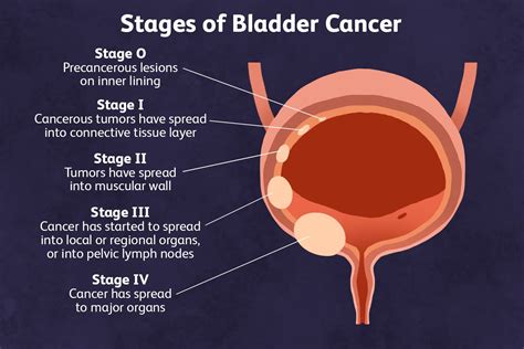 How long can you have bladder cancer and not know?