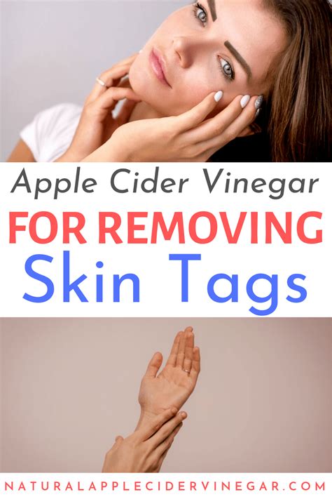 How long can you leave apple cider vinegar on a skin tag?