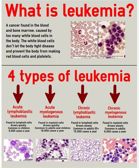 How long can you love with leukemia?