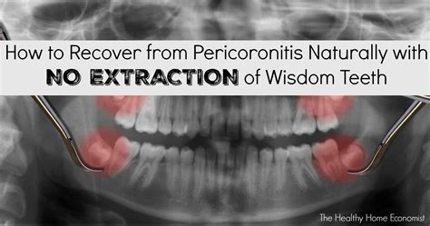 How long can you wait to treat pericoronitis?