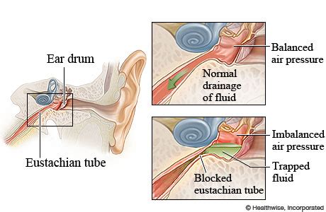 How long do Eustachian tubes stay blocked?